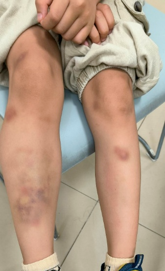 华体会体育-深圳6岁男童吃生菜包烤肉后，全身出现大片青斑、血肿